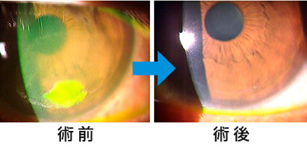 角膜混濁（PTK：レーザー治療的角膜切除術）｜南青山アイクリニック東京