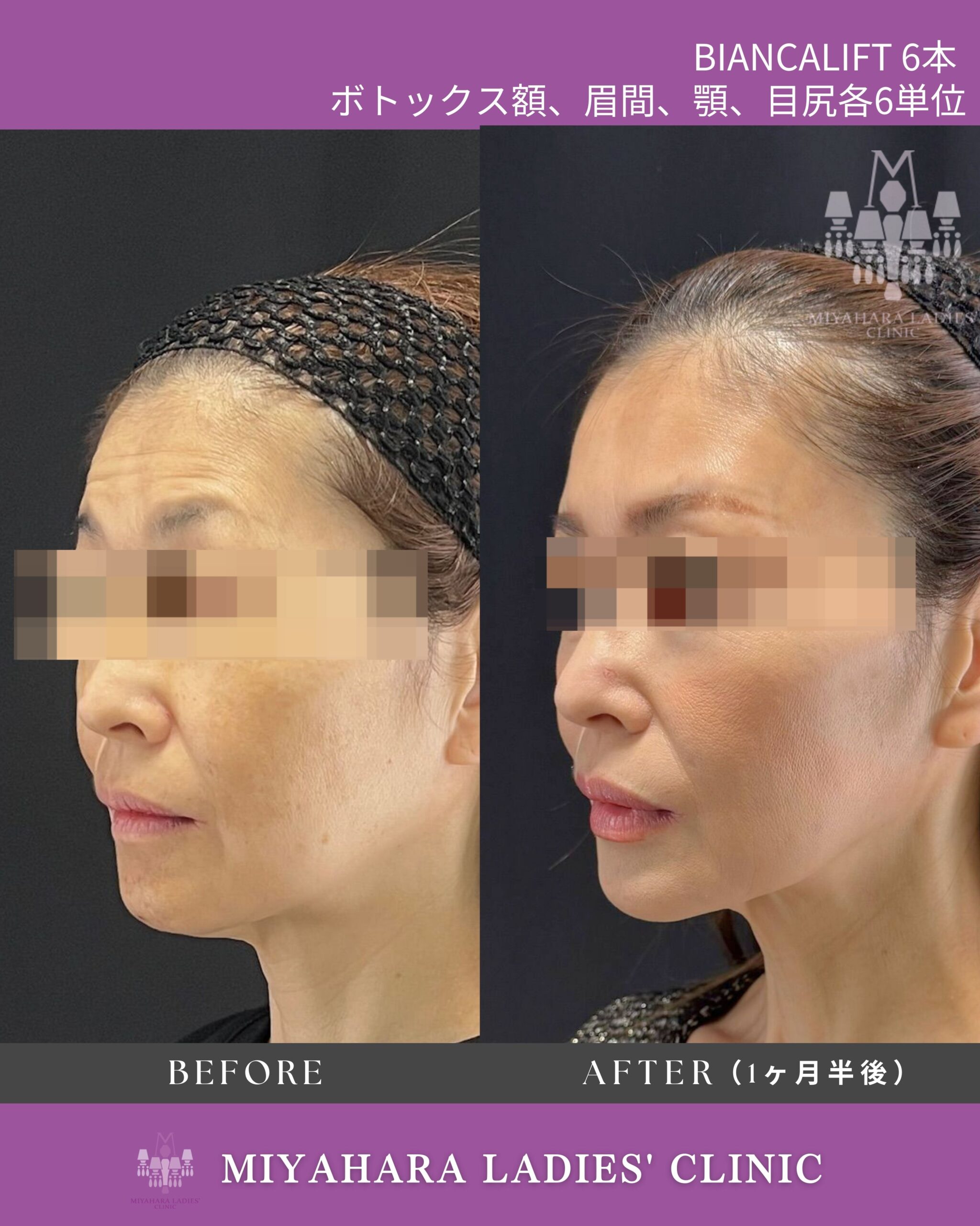 ボトックス注射 ｜ 熊本市 みやはらレディースクリニック 美容診療専用