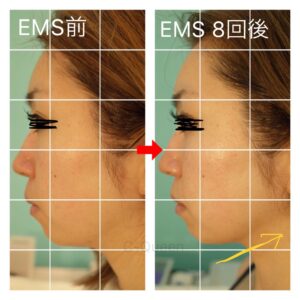 表情筋EMSマシン「小顔＆リフトUP」コース70分 – 滋賀県草津市の毛穴