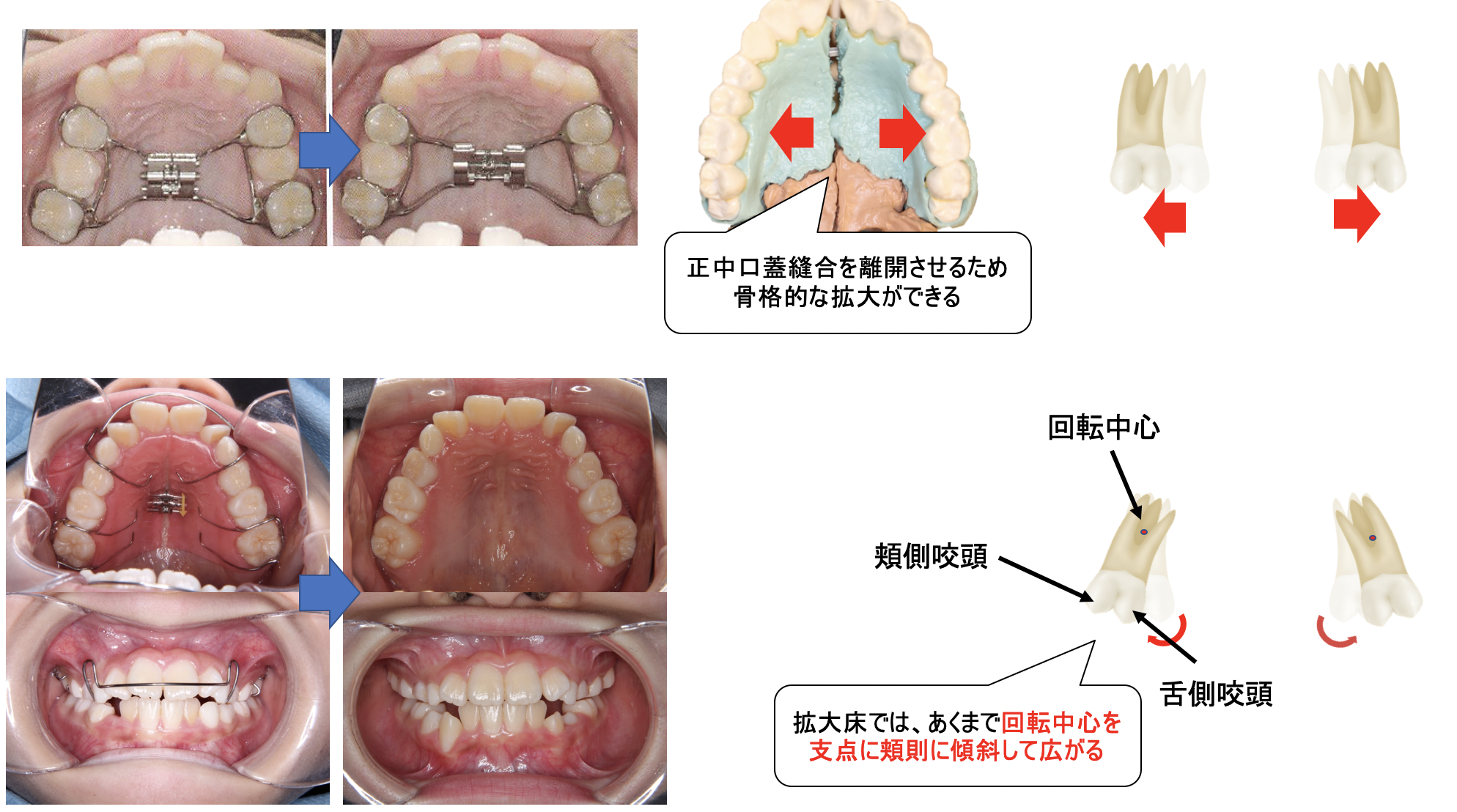 拡大床（拡大プレート/緩徐拡大装置）｜奈良の矯正歯科なら【おとなと