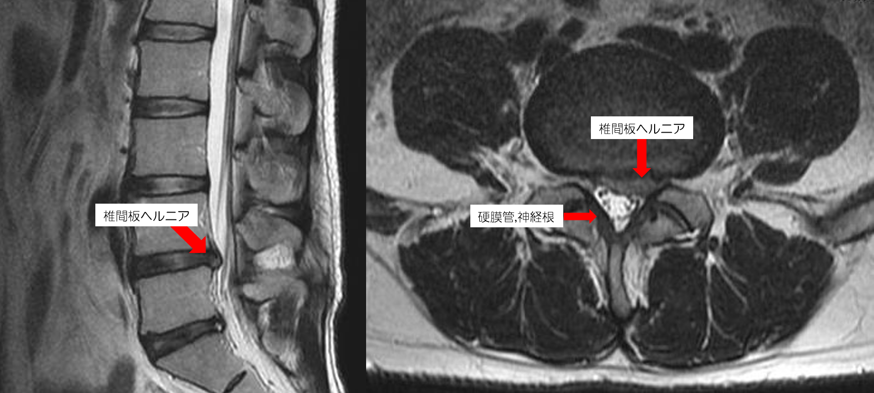 注射で治す、腰椎椎間板ヘルニア！！ 『椎間板内酵素注入療法』とは