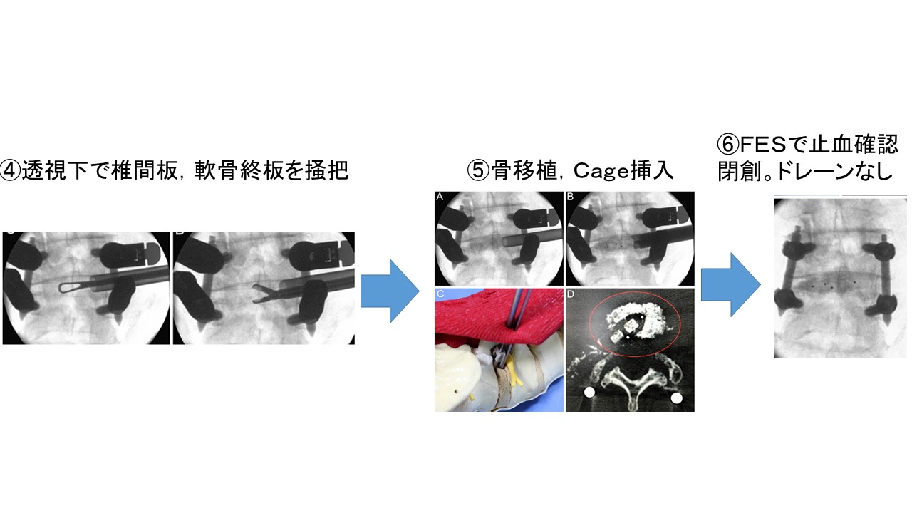 低侵襲脊椎手術PETLIF：短期間で社会復帰を可能にする手術方法 ｜ 成尾