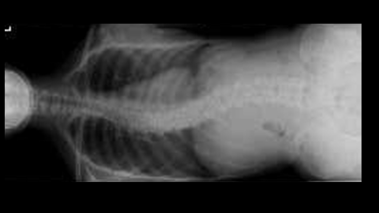 側弯症手術の最新技術をわかりやすく解説！VCA（コープレナー