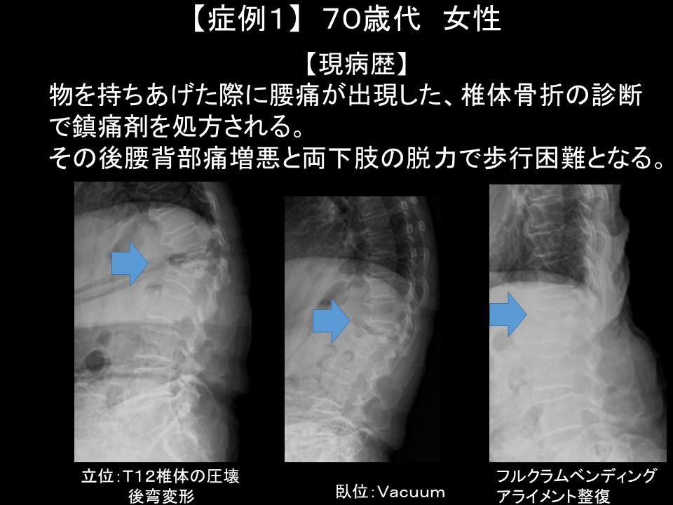 脊椎骨折の見逃しに要注意！診断遅れが引き起こすリスクとその対策