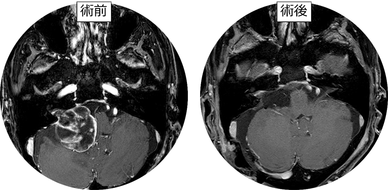 小脳橋角部腫瘍 | 筑波大学附属病院脳神経外科