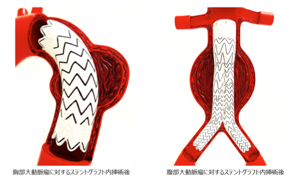 ステントグラフト内挿術(大動脈瘤の手術)- 東京の血管外科- ニュー