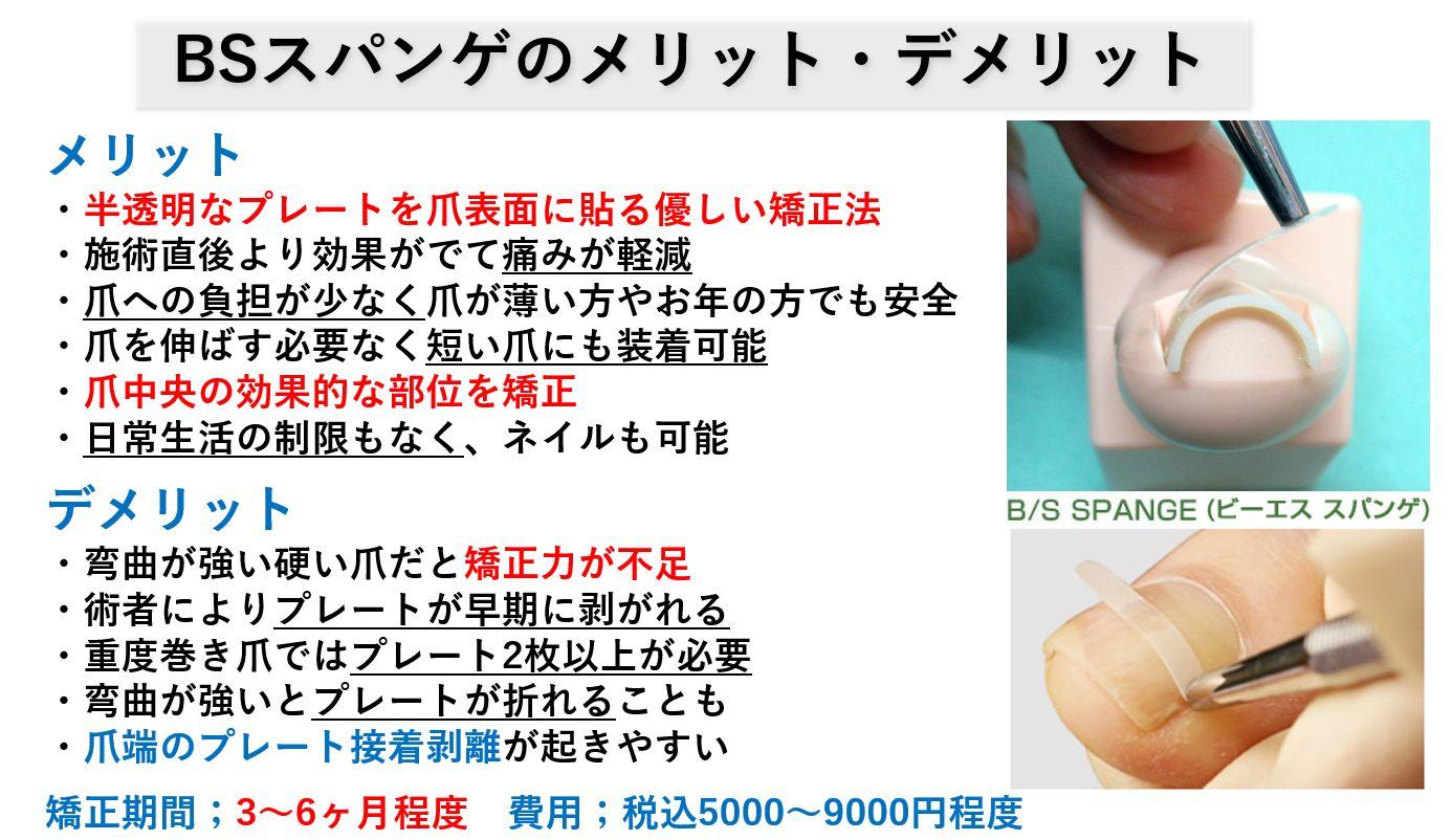 巻き爪矯正ワイヤー治療/病院おすすめ矯正器具の効果｜大田区大森