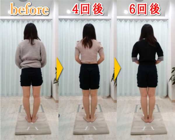 O脚矯正ビフォーアフター｜大阪のO脚矯正『整体院 そるん』