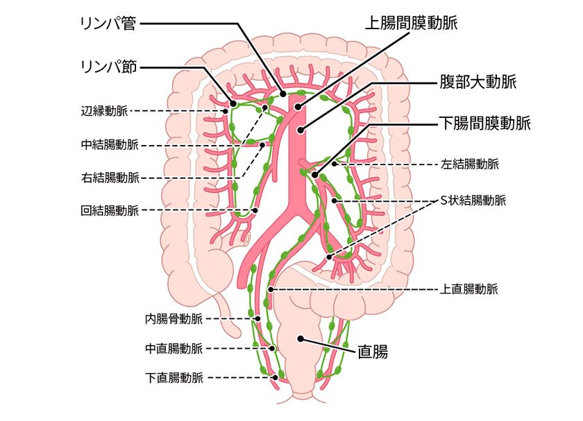 大腸がん｜大阪国際がんセンター