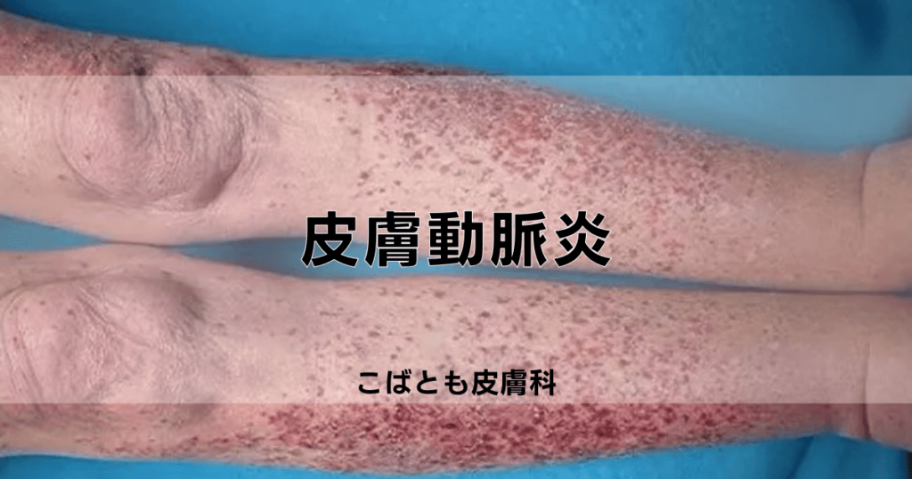 血管炎｜こばとも皮膚科｜栄駅（名古屋市栄区）徒歩2分