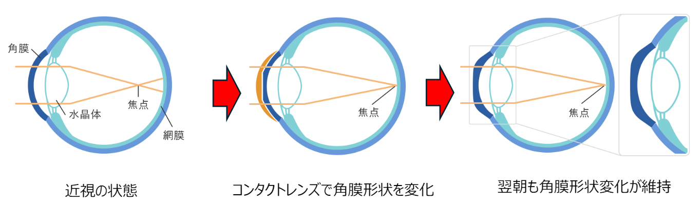 オルソケラトロジー（近視進行抑制と視力矯正） - 十川眼科 大町院
