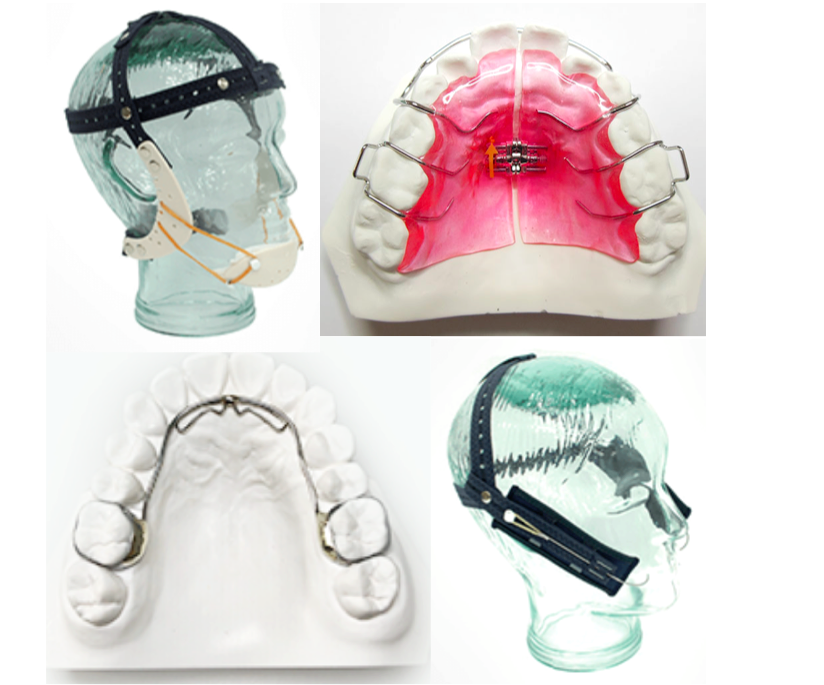 子供の矯正｜小児で使用する装置は3種類あります！｜ 名古屋市千種区