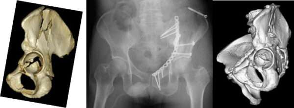 骨盤・寛骨臼骨折 - 福島県立医科大学 整形外科学講座