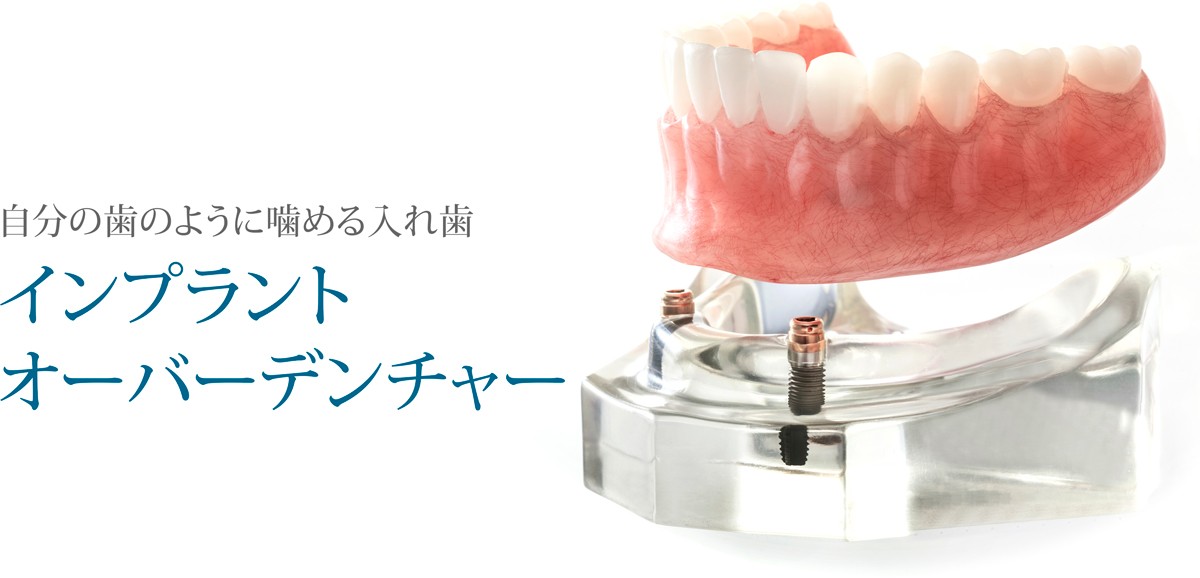 インプラントオーバーデンチャー | 診療内容 | おざき歯科医院