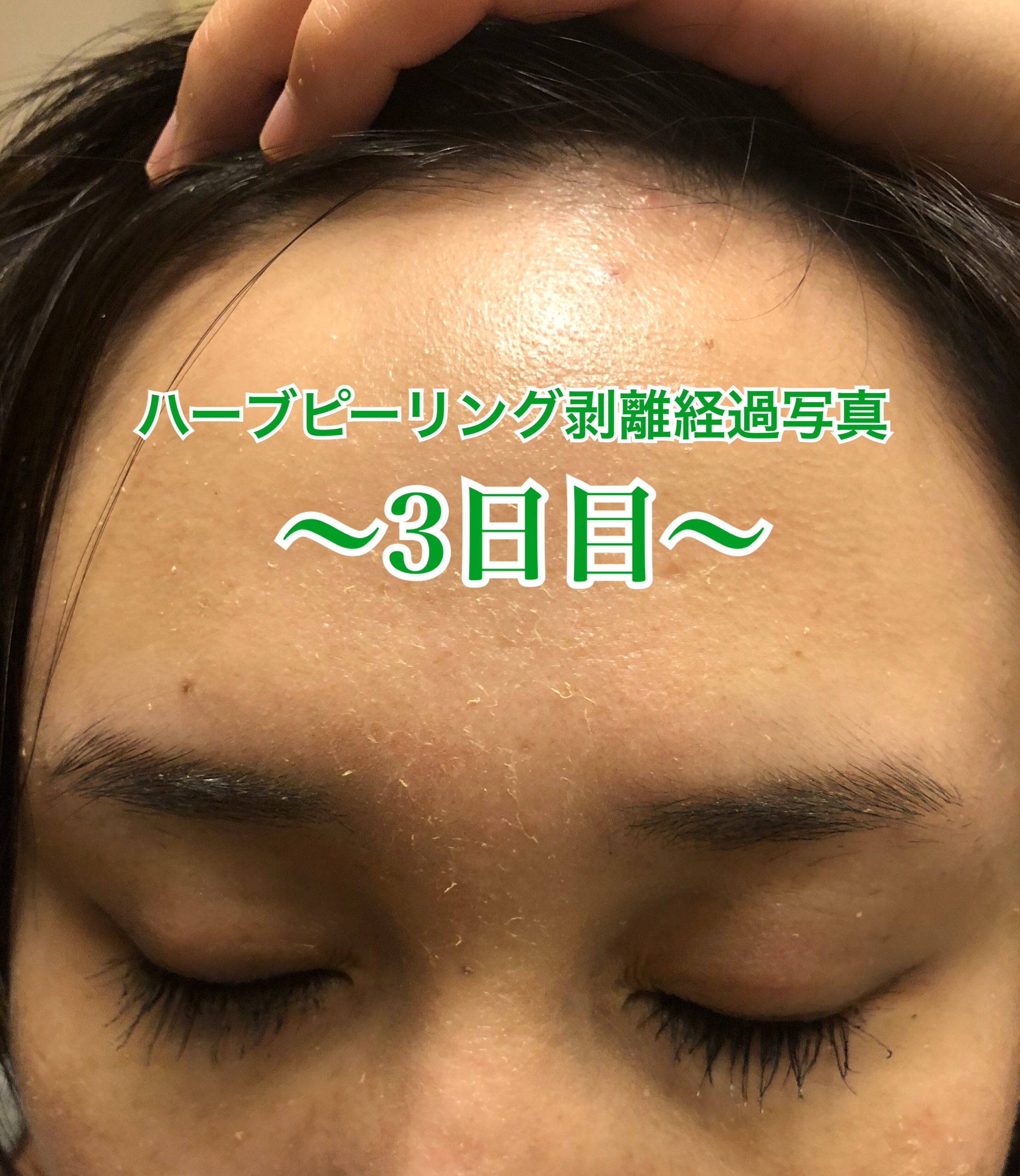 ハーブピーリング剥離経過写真～3日目～ | 小顔矯正サロンぱうざグループ
