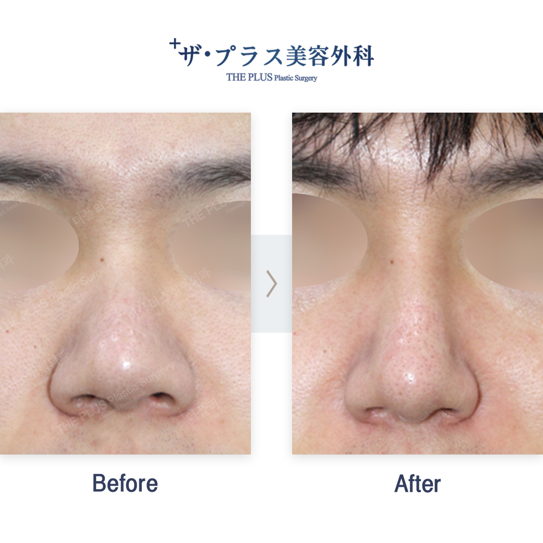 鼻形成】 👨‍⚕️ジョン先生執刀の鼻の患者様の症例です✨ ◇ 初めての