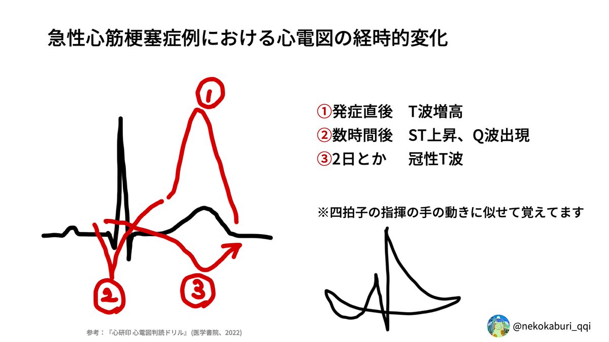 AMIの心電図変化】 今年も、明日から心電図検定ですね。 急性心筋梗塞