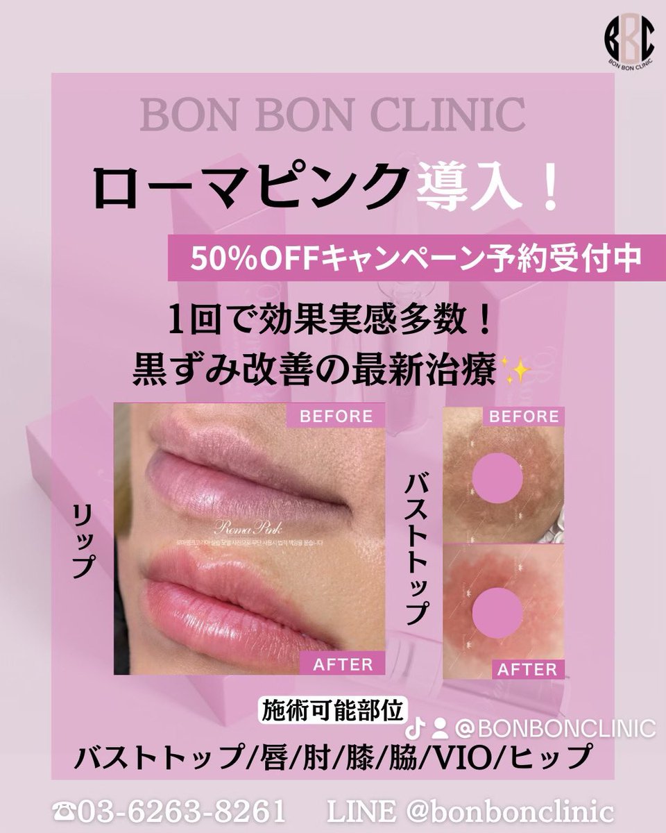 ✨大人気！ローマピンク50％OFFキャンペーン中✨ ローマピンクとは