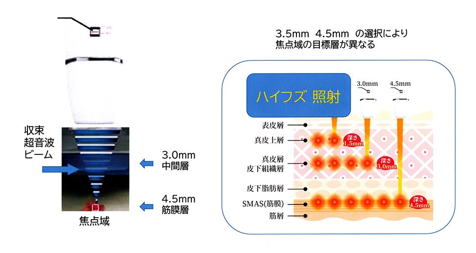 ハイフうち放題でハイフとラジオ波が同時に使える 家庭用ハイフ 複合