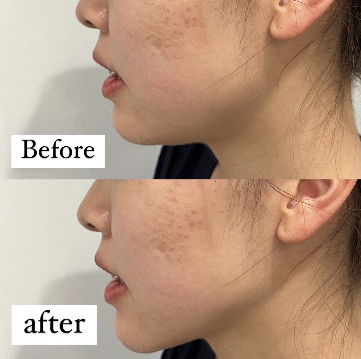 4D HIFU | プライベートクリニック恵比寿｜美容外科・美容皮膚科