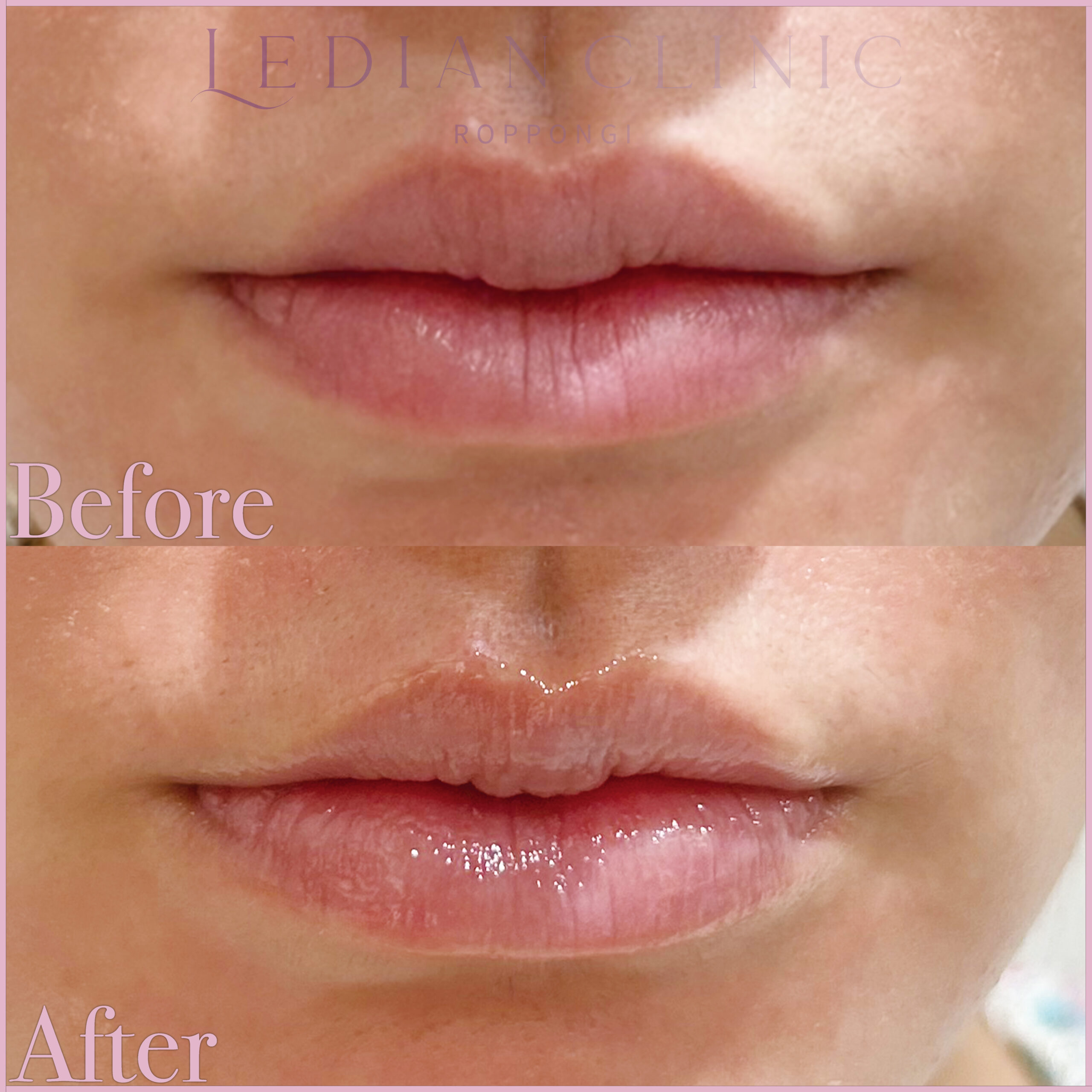 ローマピンク | Ledian Clinic（レディアンクリニック六本木）| 六本木
