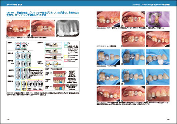 オーバーレイ修復”のステップや 勘所をビジュアルに解説した1冊