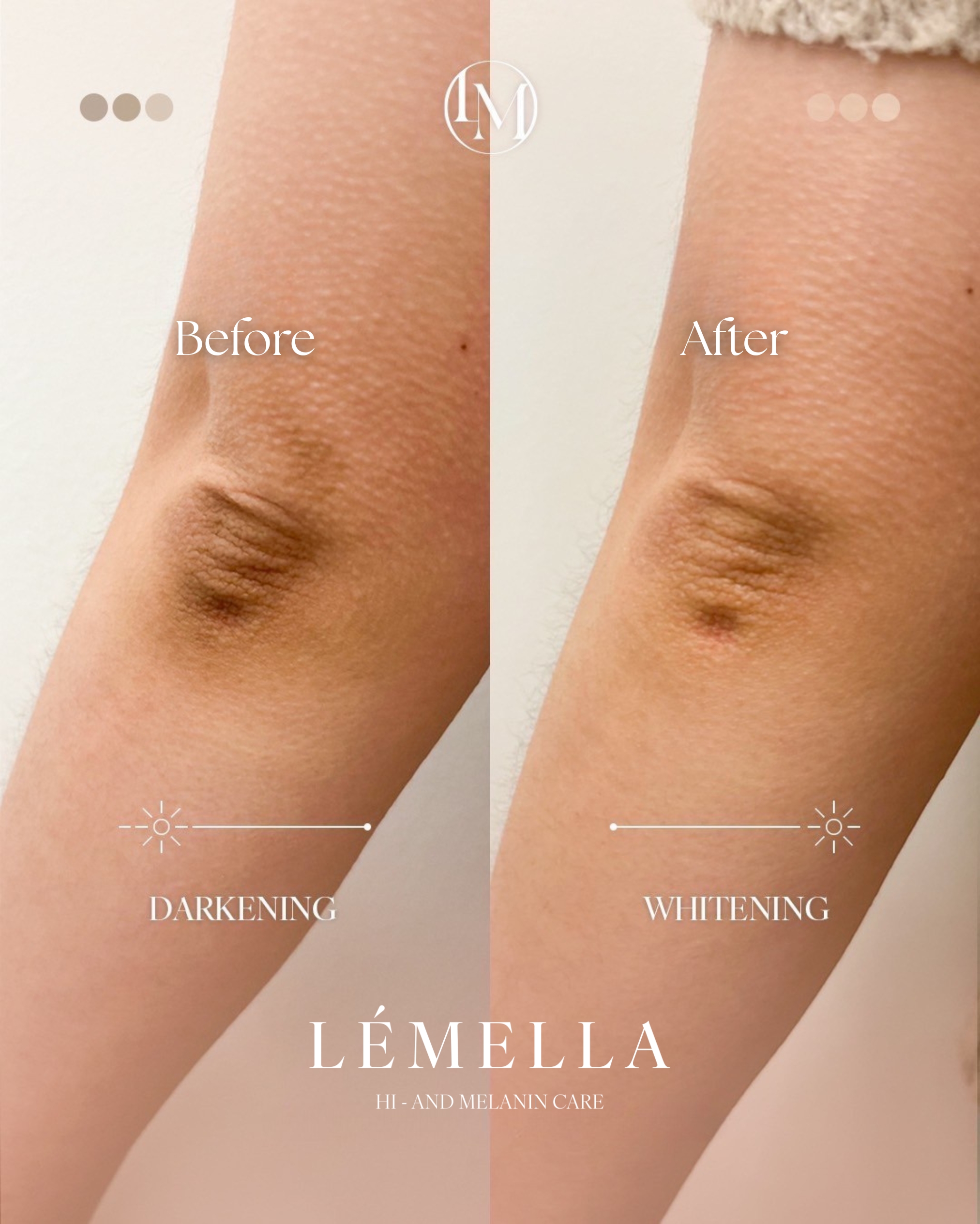 ルメラ - 表参道レジュバメディカルクリニックforWOMEN