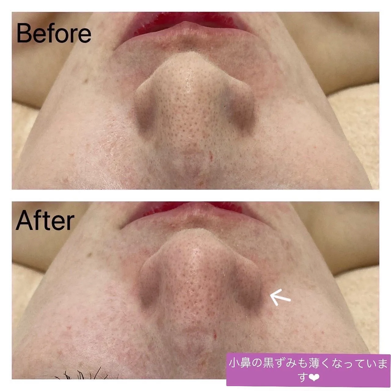 毛穴の黒ずみ汚れは水素水で吸引できる毛穴洗浄ハイドロスプラッシュ