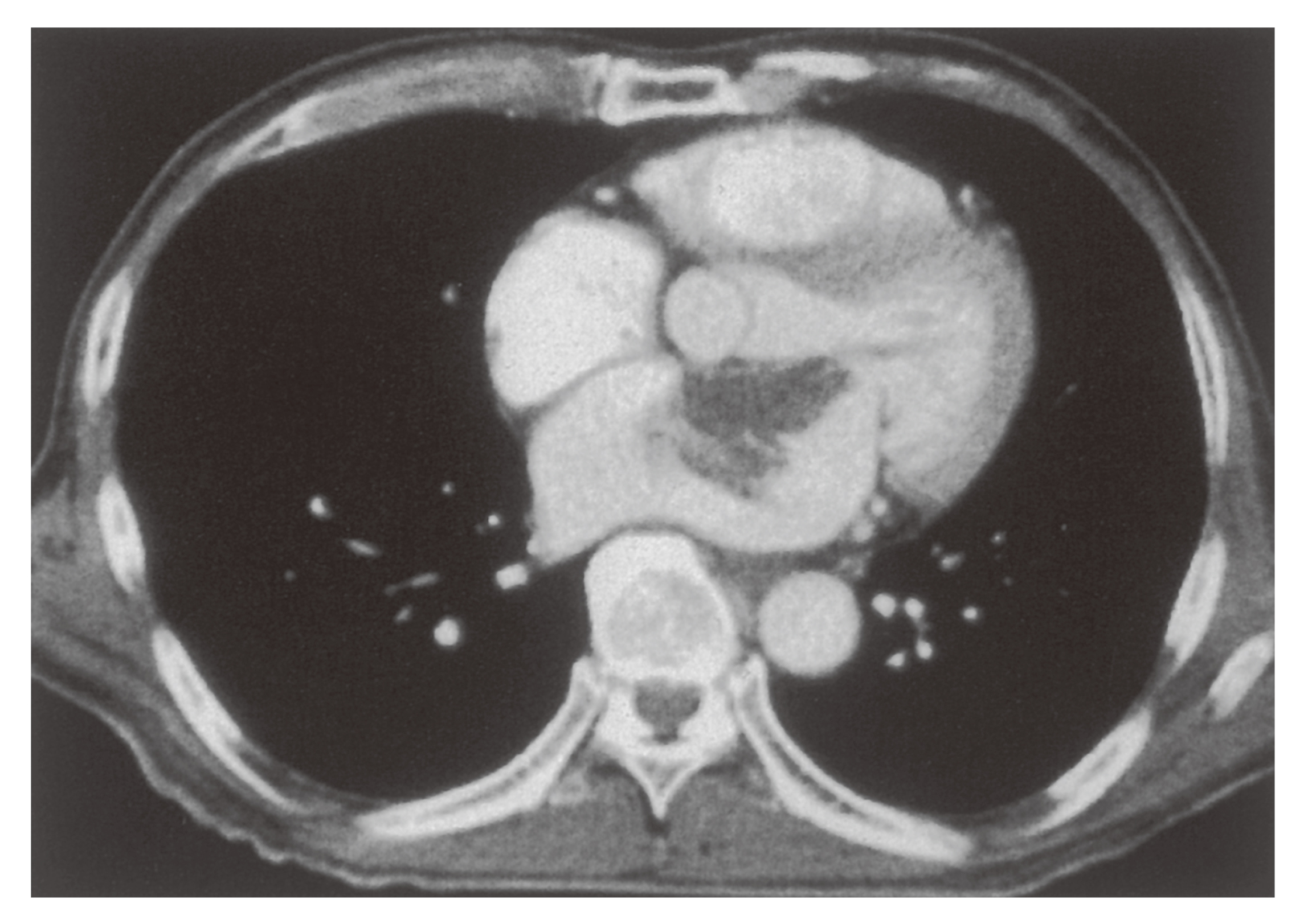 100A21 | 心臓腫瘍 国試 | テコプラ
