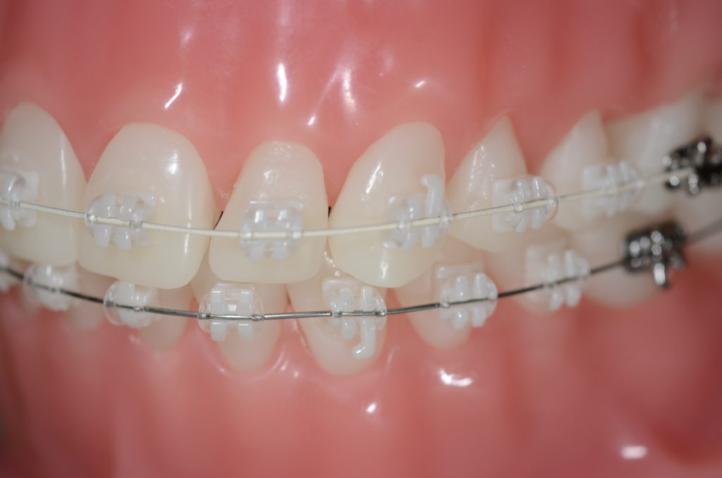 矯正装置（様々なブラケット） | 福岡市博多区博多駅近くの矯正歯科