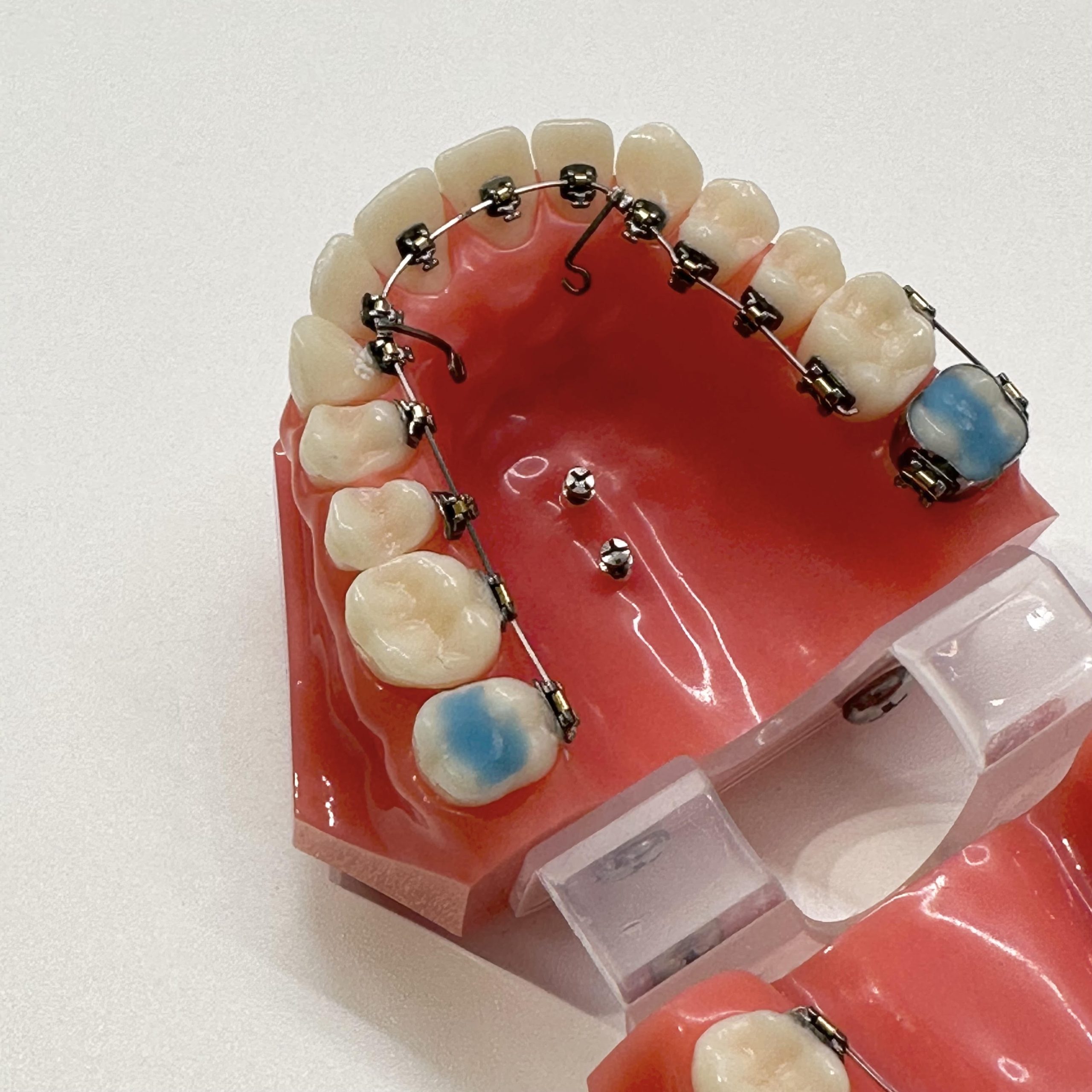 歯科矯正用アンカースクリューって何？ | 札幌キュア矯正歯科