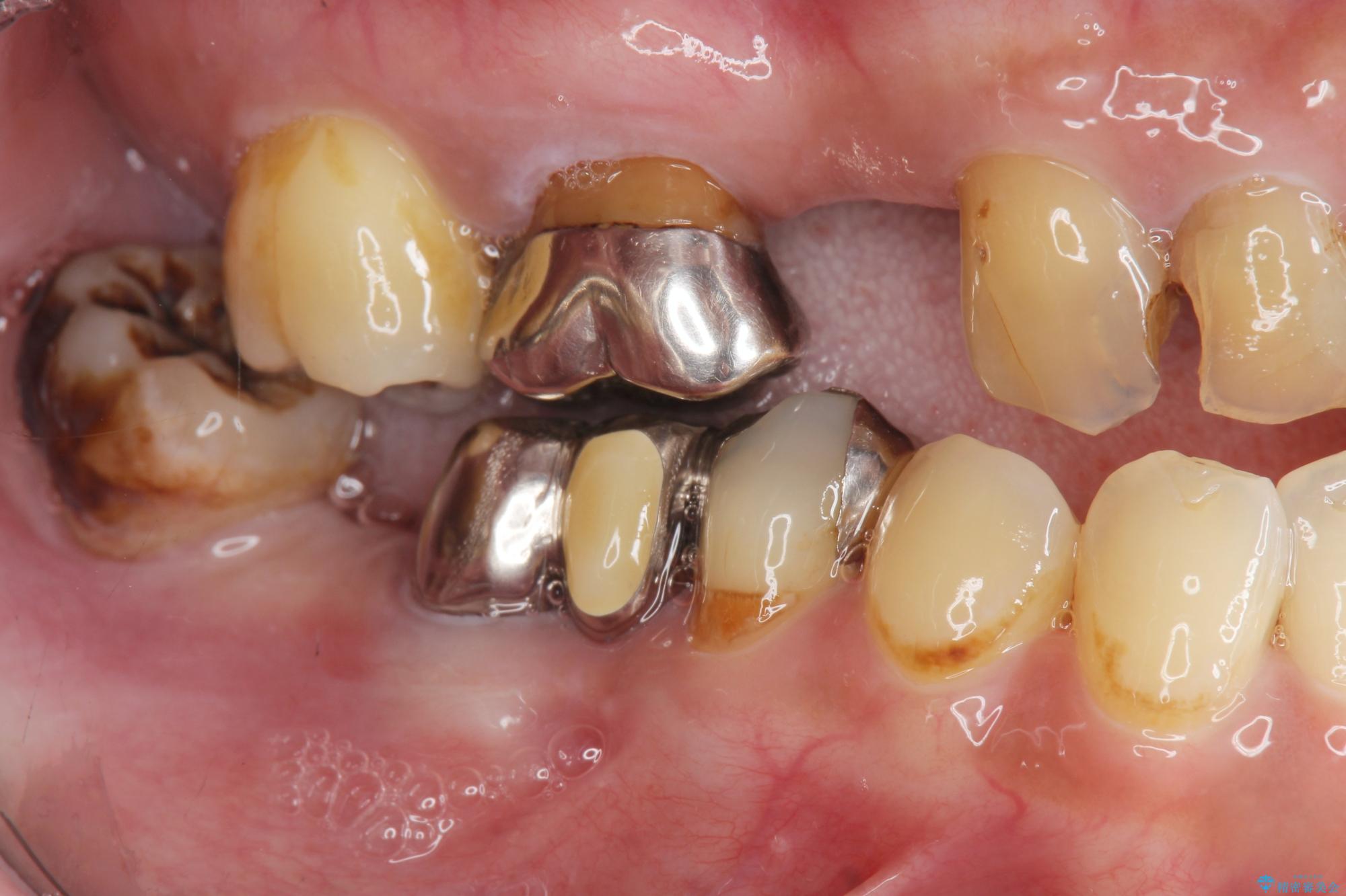 奥歯でしっかり噛めない ] インプラント治療で咬合機能の回復｜（医