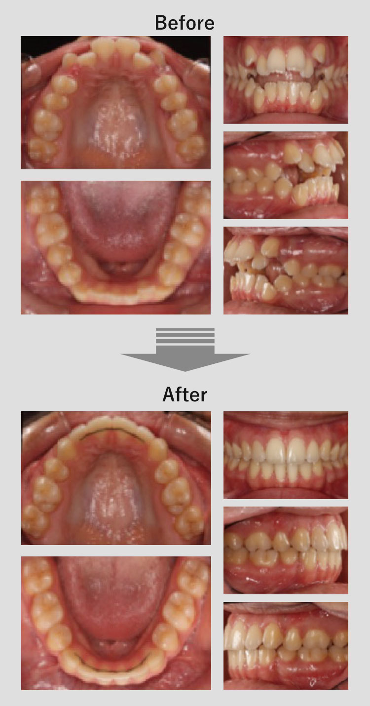 プレシジョン矯正治療(光加速矯正) | 新橋歯科医科診療所［痛くない