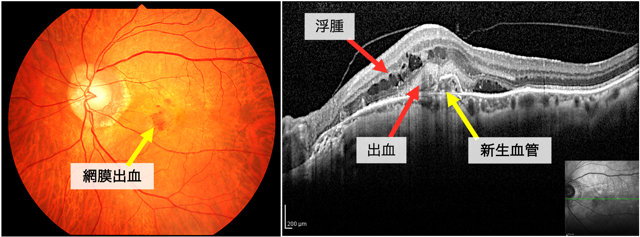 加齢黄斑変性 | 新小岩眼科