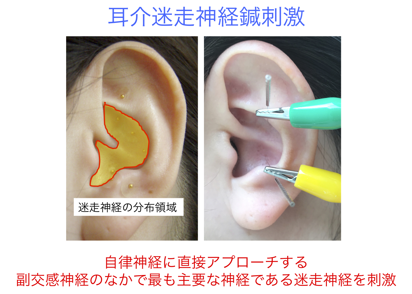 NHK BS「フロンティア」『東洋医学とは何か』で、経皮的耳介迷走神経