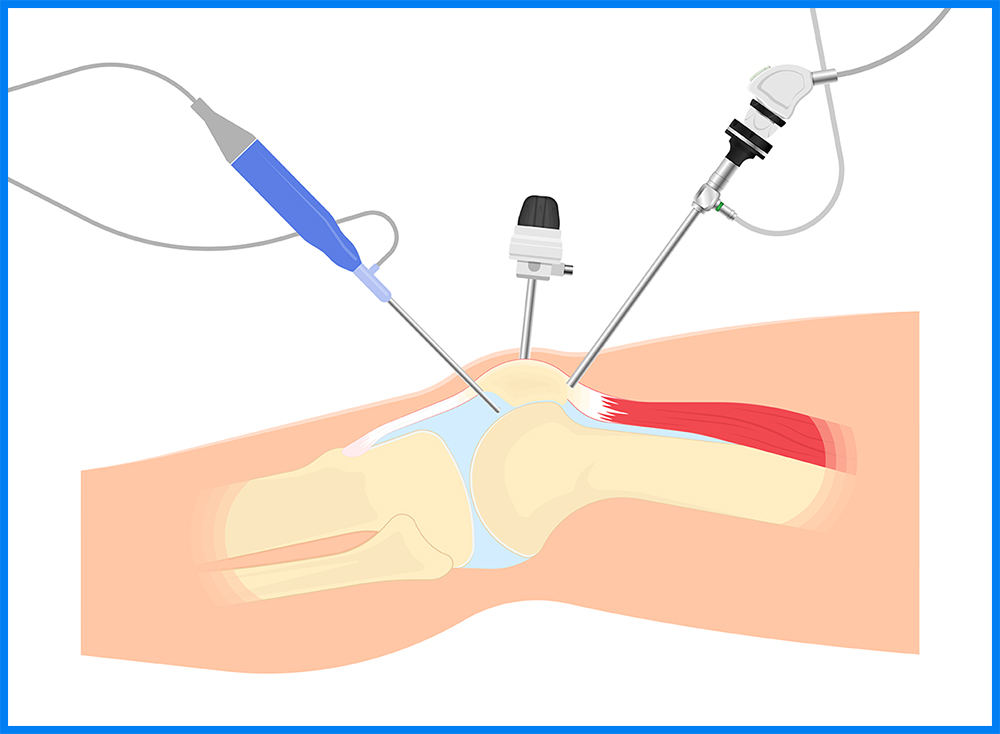 膝関節鏡下手術とは・・・どんな手術？ | 札幌いがらし人工関節クリニック