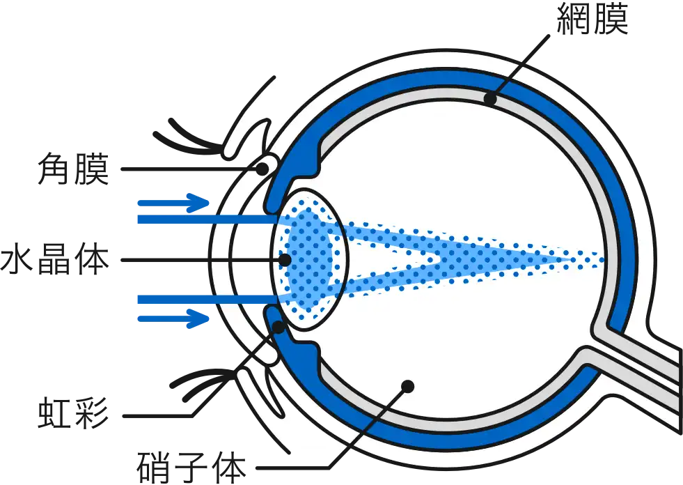 白内障手術 | 十川眼科