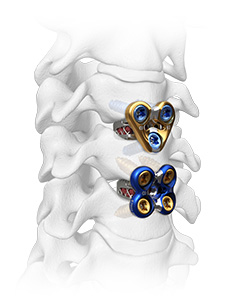 Sapphire X® - Spinal Elements