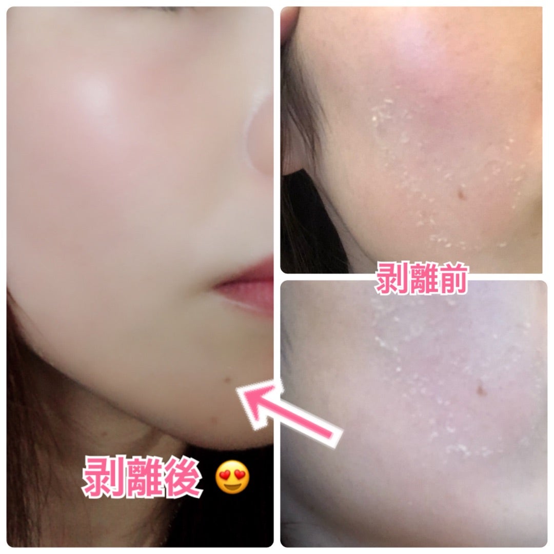 BKハーバル ハーブピーリング 5dayピールキット（剥離あり） 剥離有り