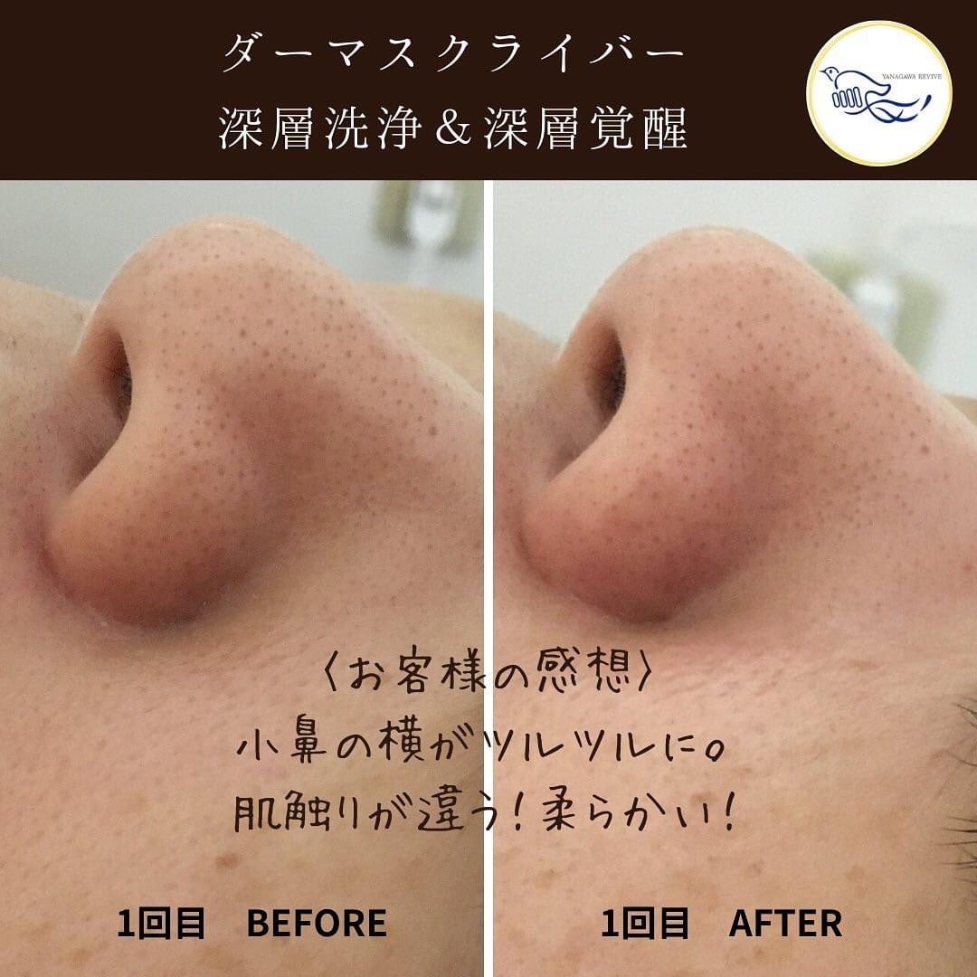 肌が柔らかい！ダーマスクライバー毛穴洗浄 | 柳川リバイブ整骨院・整体院