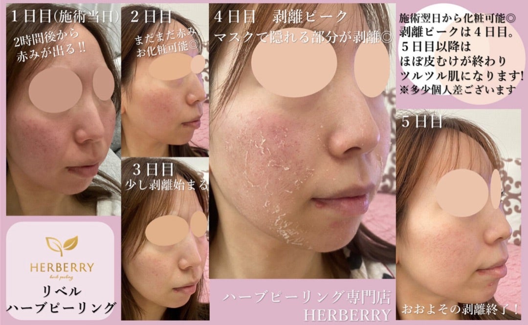 剥離ありリベルハーブピーリング、ダウンタイムは5日! | ハーブ