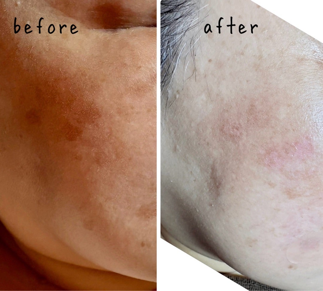 シミ・スポットケアキャンペーン | なごみのブログ