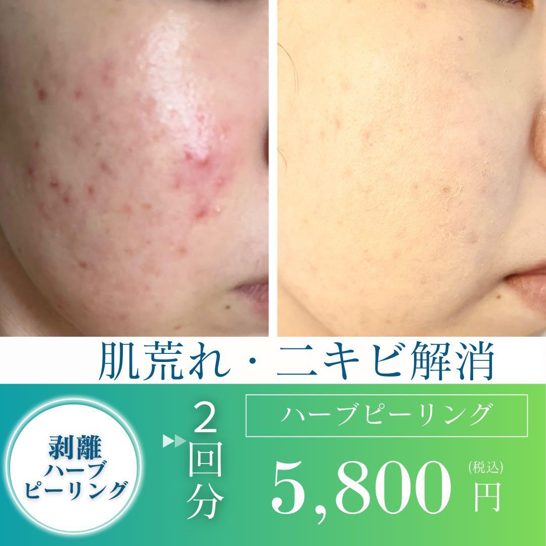 ハーブピーリング剥離あり - メルカリ