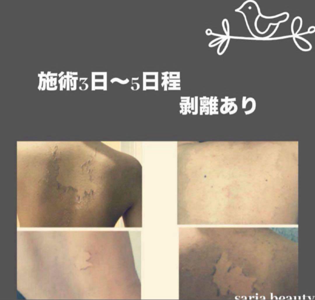 ハーブピーリング 業務用 剥離あり CICA アロエベラ オーガニック 和漢