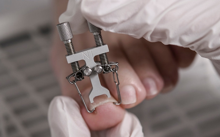 巻き爪・トラブルネイルケアシステム「ネイルトリム」、 ネイル用