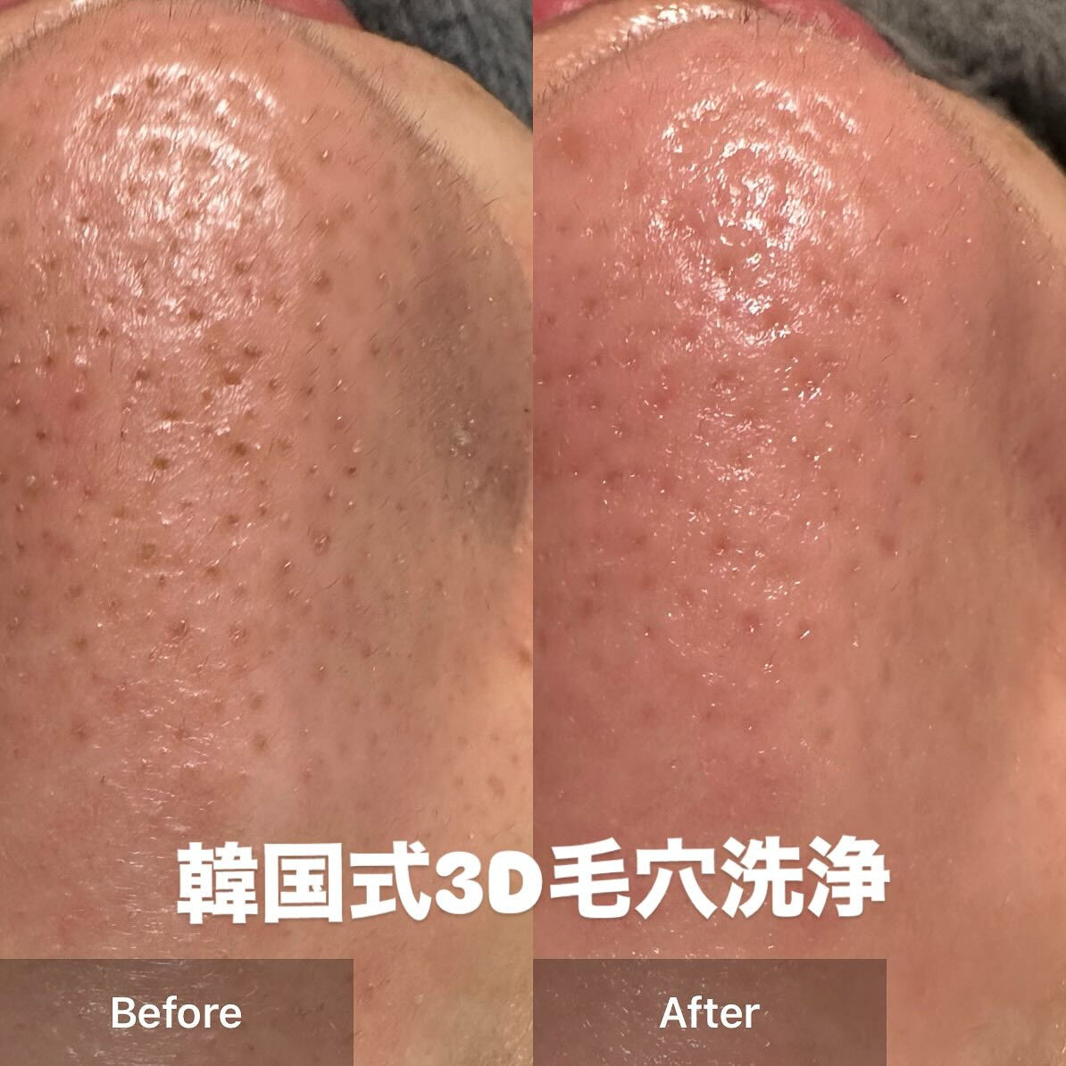 韓国式3D毛穴洗浄☆HARIKANジェル 韓国式3D毛穴洗浄☆HARIKANジェル